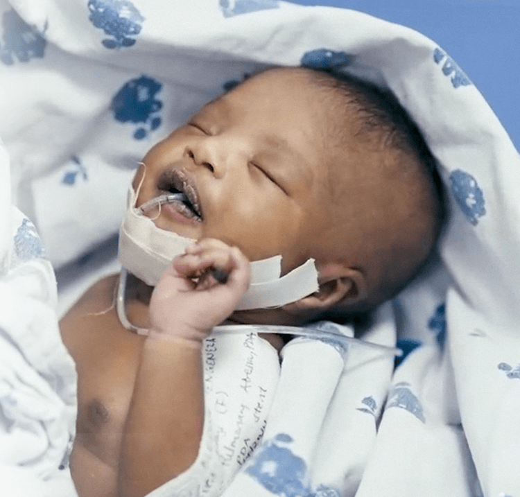 Blessing, a Little Hearts patient in Tanzania